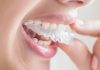Invisalign Braces